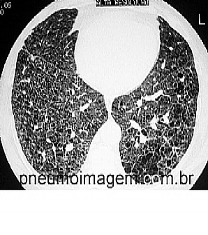 DESTAQUES DO ERS 2014: TRANSPLANTE DE PULM�O BILATERAL PARECE SER MELHOR OP��O QUE O UNILATERAL